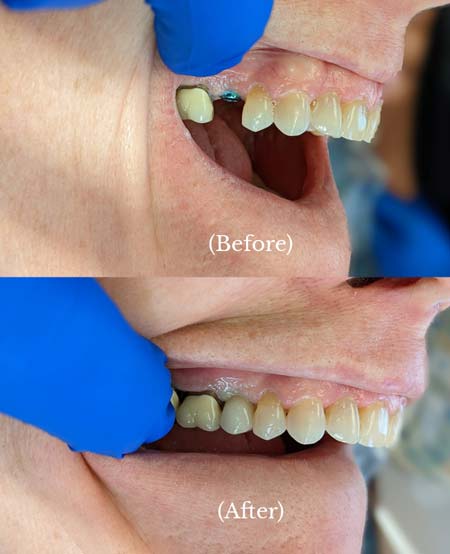 Dental Implants Before & After Jericho, NY Patient